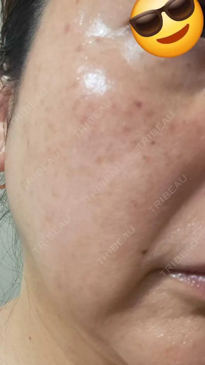 水光注射（ハリ・美肌） しんゆり美容健康クリニック DAY 3 メイン用