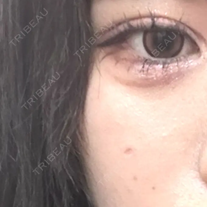 ほくろ・いぼ切除（肌） / ボトックス（口角） TCB東京中央美容外科 仙台駅前院 DAY 8 メイン用