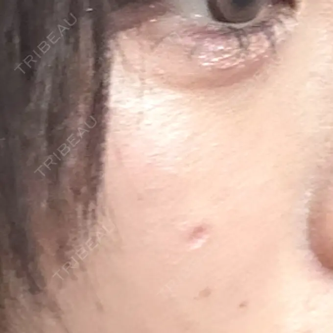 ほくろ・いぼ切除（肌） / ボトックス（口角） TCB東京中央美容外科 仙台駅前院 DAY 8 メイン用