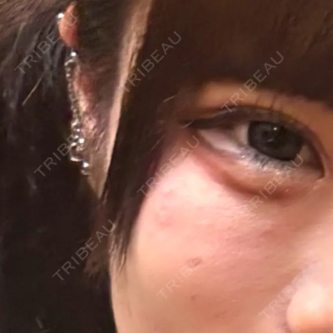 ほくろ・いぼ切除（肌） / ボトックス（口角） TCB東京中央美容外科 仙台駅前院 AFTER メイン用