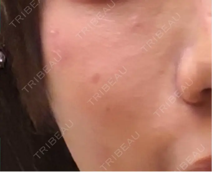 ほくろ・いぼ切除（肌） / ボトックス（口角） TCB東京中央美容外科 仙台駅前院 DAY 29 メイン用