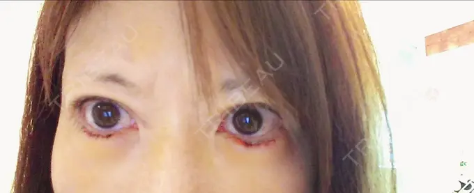 糸リフト / タレ目形成・グラマラスライン（切開） / ボトックス（あご） 品川スキンクリニック広島院 DAY 4 メイン用