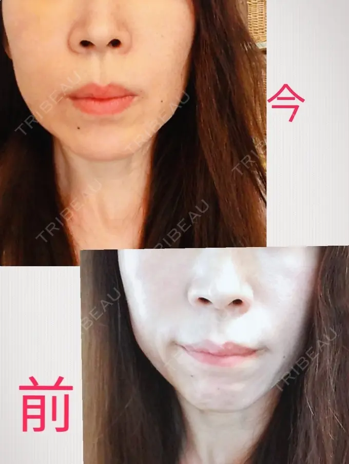 糸リフト / タレ目形成・グラマラスライン（切開） / ボトックス（あご） 品川スキンクリニック広島院 DAY 4 メイン用