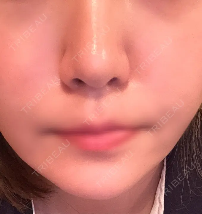 その他（口元） フィラークリニック 新宿院 AFTER メイン用