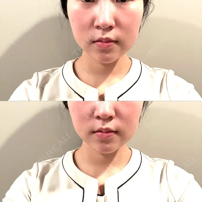 脂肪吸引（顔） / ボトックス（エラ・小顔） Mods Clinic（モッズクリニック） 名古屋院 DAY 92 メイン用