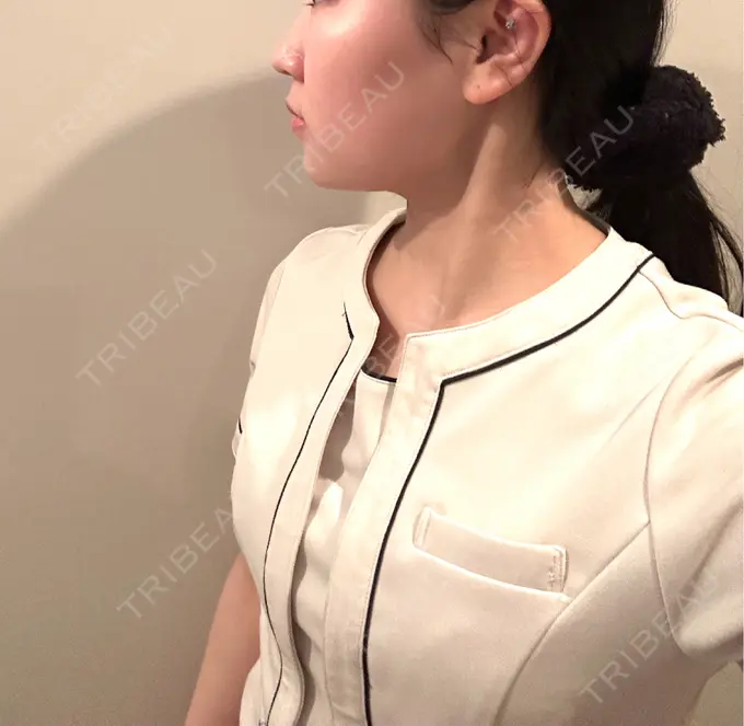 脂肪吸引（顔） / ボトックス（エラ・小顔） Mods Clinic（モッズクリニック） 名古屋院 DAY 92 メイン用