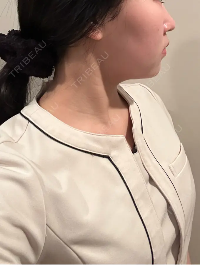 脂肪吸引（顔） / ボトックス（エラ・小顔） Mods Clinic（モッズクリニック） 名古屋院 DAY 92 メイン用