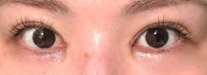 二重埋没 / 目頭切開 / その他（目元） eクリニック 福岡院 DAY 7 メイン用