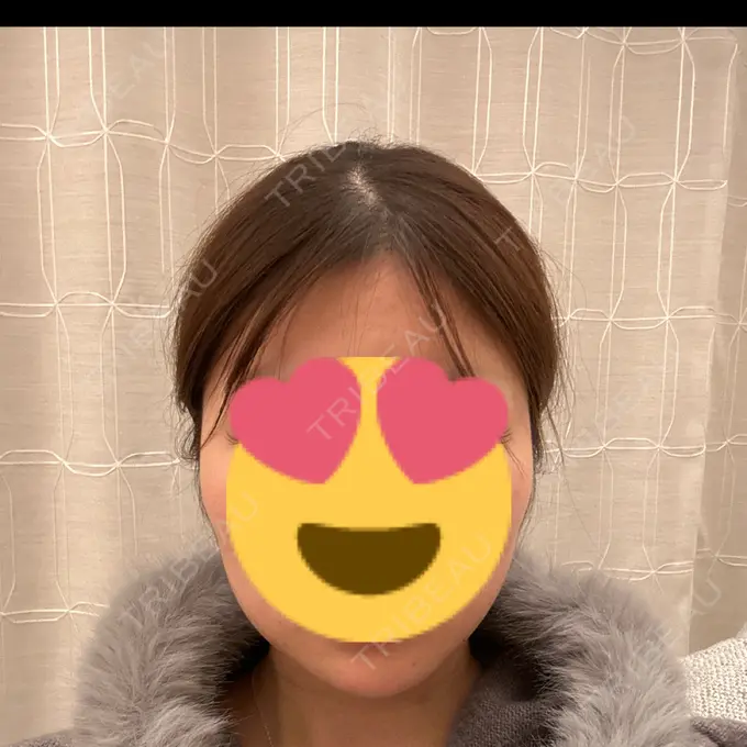 ボトックス（エラ・小顔） 共立美容外科 名古屋院 DAY 0 メイン用