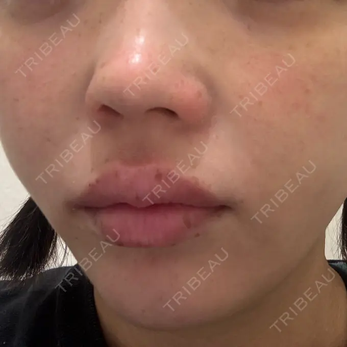 ピコレーザートーニング（美白・肝斑） ルラ美容クリニック 広島院 AFTER メイン用