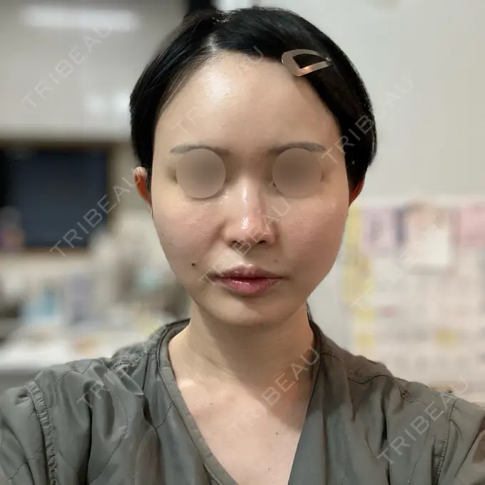 RF（高周波）たるみ治療 Chloe Cheongdam Clinic （クロエチョンダムクリニック） DAY 0 メイン用