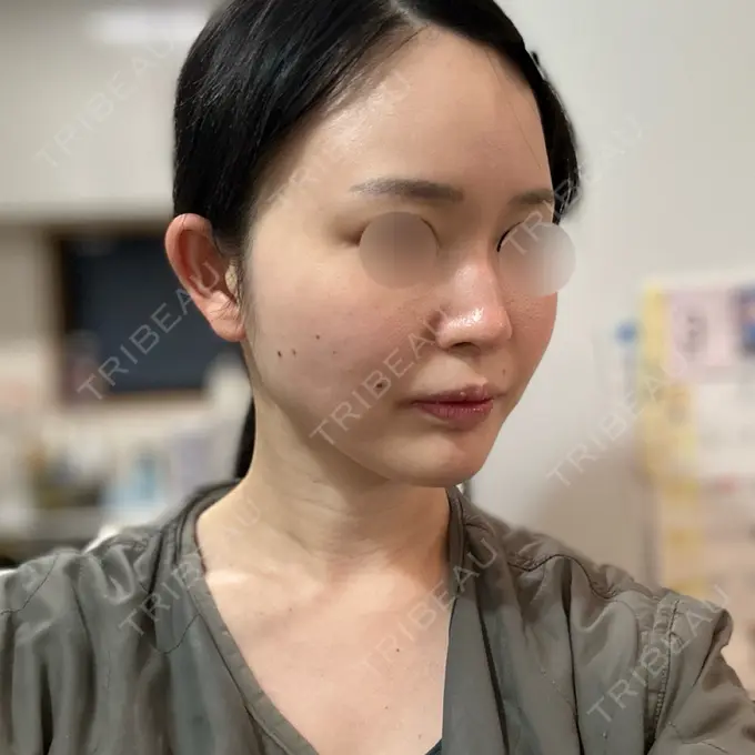 RF（高周波）たるみ治療 Chloe Cheongdam Clinic （クロエチョンダムクリニック） DAY 0 メイン用