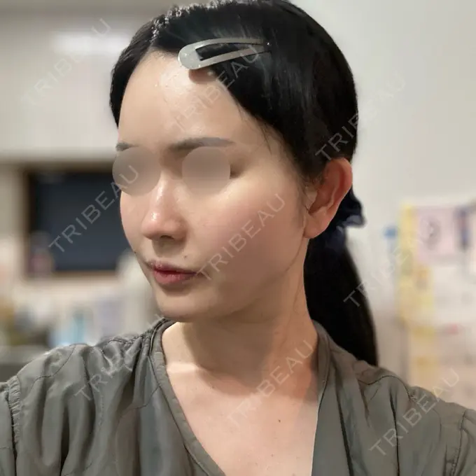 RF（高周波）たるみ治療 Chloe Cheongdam Clinic （クロエチョンダムクリニック） DAY 0 メイン用