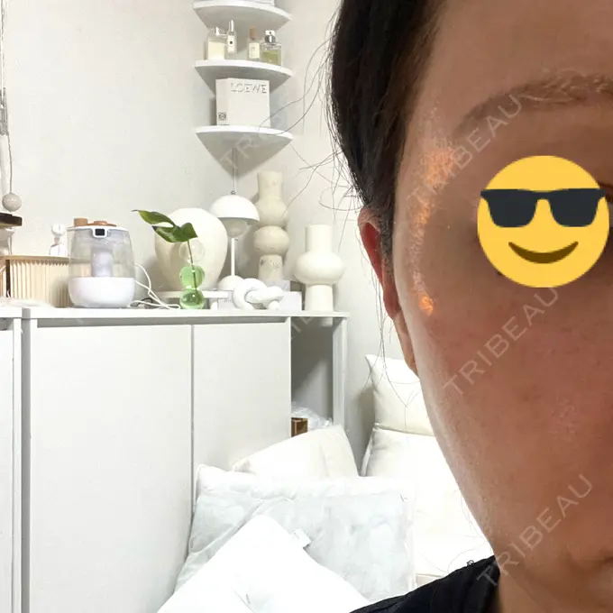 水光注射（ハリ・美肌） しんゆり美容健康クリニック AFTER メイン用