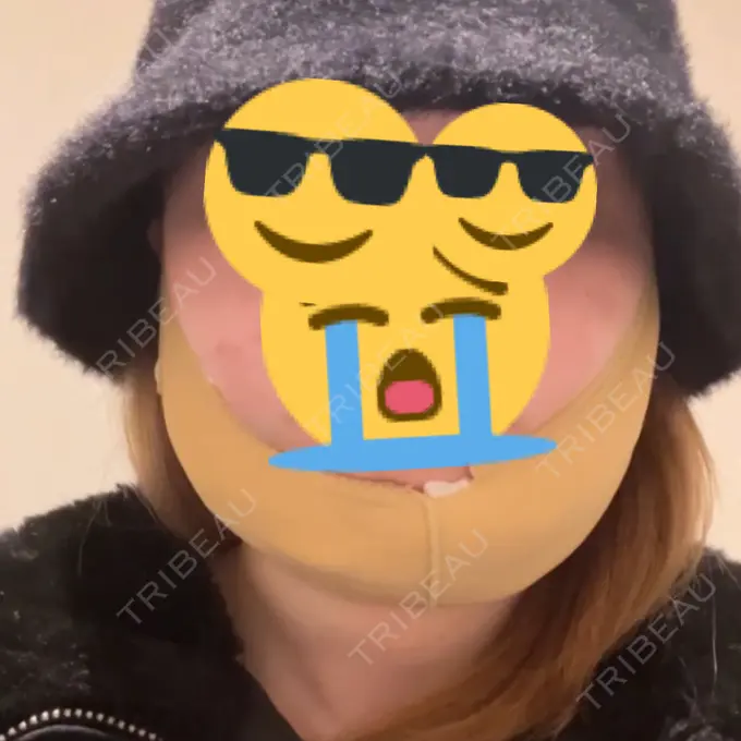 糸リフト / 脂肪吸引（顔） ヴェルトラクリニック 新宿院 DAY 0 メイン用