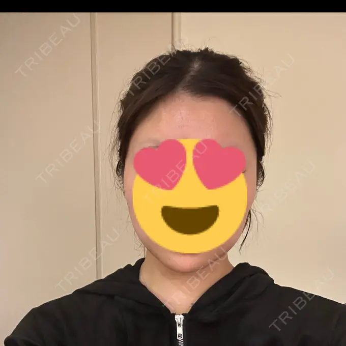 ボトックス（エラ・小顔） 共立美容外科 名古屋院 DAY 1 メイン用