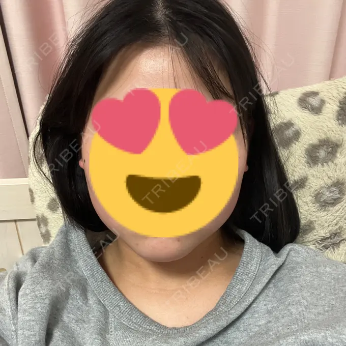 RF（高周波）たるみ治療 RIVER CLINIC（リバークリニック） DAY 21 メイン用