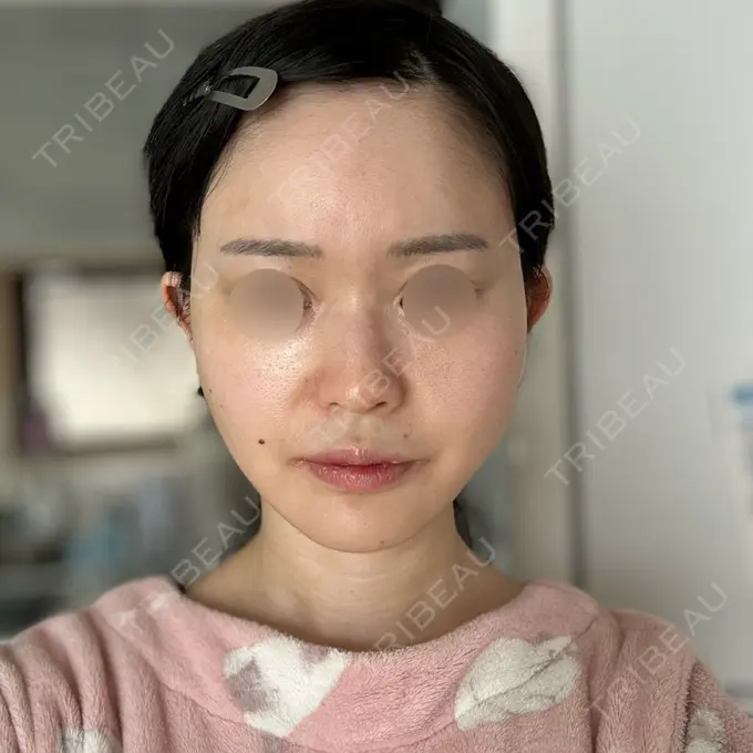 RF（高周波）たるみ治療 Chloe Cheongdam Clinic （クロエチョンダムクリニック） DAY 2 メイン用