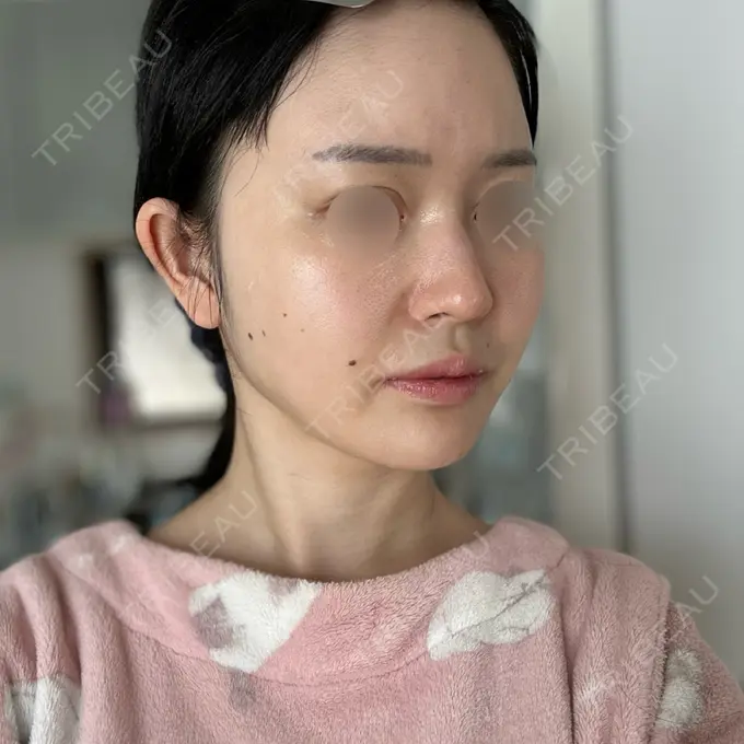 RF（高周波）たるみ治療 Chloe Cheongdam Clinic （クロエチョンダムクリニック） DAY 2 メイン用