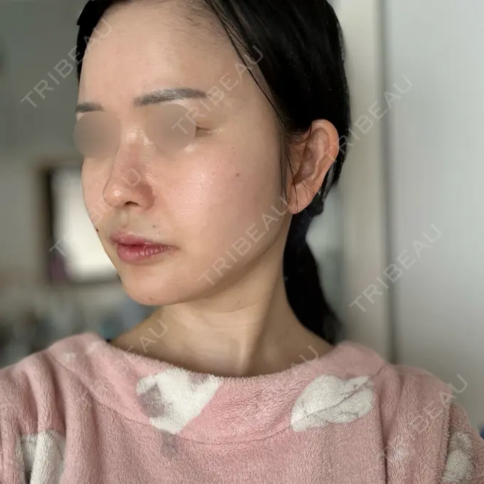 RF（高周波）たるみ治療 Chloe Cheongdam Clinic （クロエチョンダムクリニック） DAY 2 メイン用