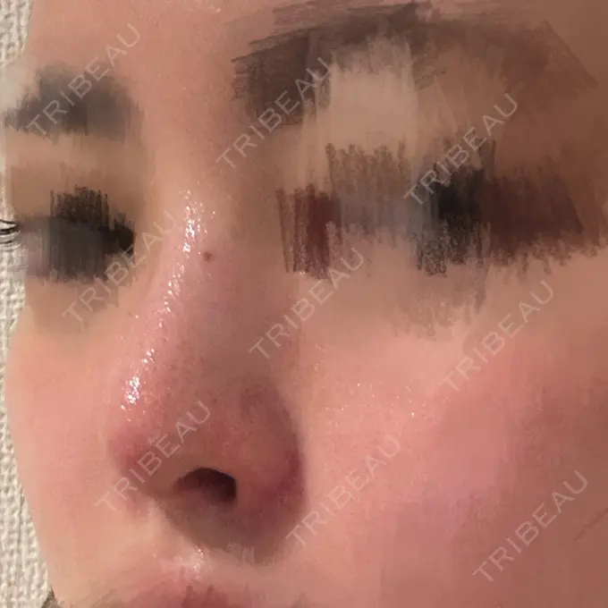 隆鼻術 / 鼻尖形成（切開） / 鼻中隔延長（切開） / 軟骨移植 / 鼻孔縁挙上 / 鼻孔縁下降 / 鼻翼基部形成（貴族手術） / その他（鼻） Designo Clinic （デジーノクリニック） DAY 47 メイン用