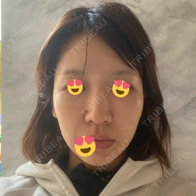 ヒアルロン酸注入（鼻） / ヒアルロン酸注入（頬） 百人町アルファクリニック DAY 1 メイン用