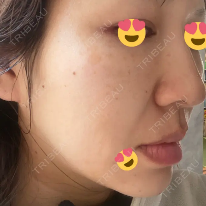 ヒアルロン酸注入（鼻） / ヒアルロン酸注入（頬） 百人町アルファクリニック DAY 1 メイン用