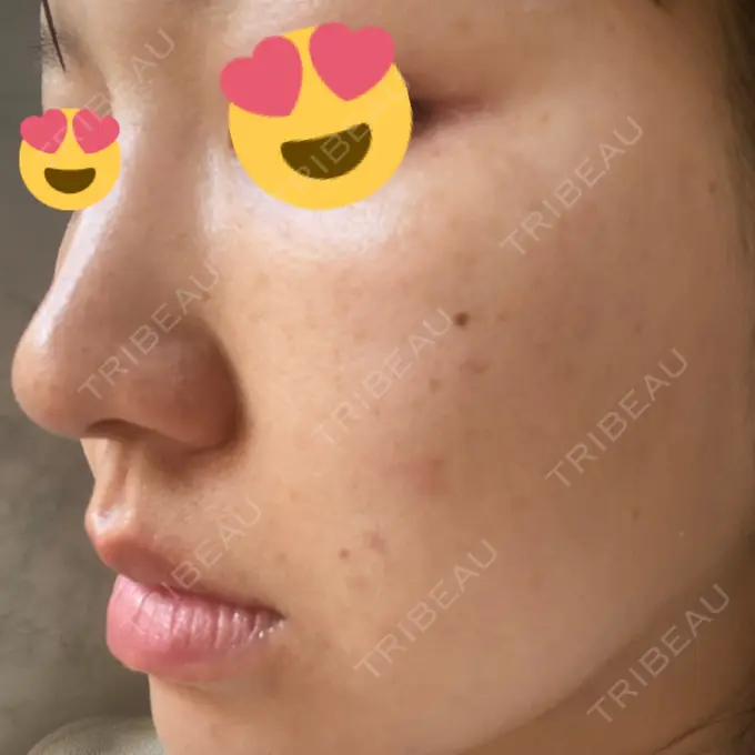 ヒアルロン酸注入（鼻） / ヒアルロン酸注入（頬） 百人町アルファクリニック DAY 1 メイン用