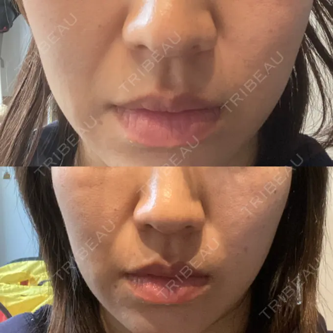 ヒアルロン酸注入（鼻） / ヒアルロン酸注入（頬） 百人町アルファクリニック DAY 4 メイン用