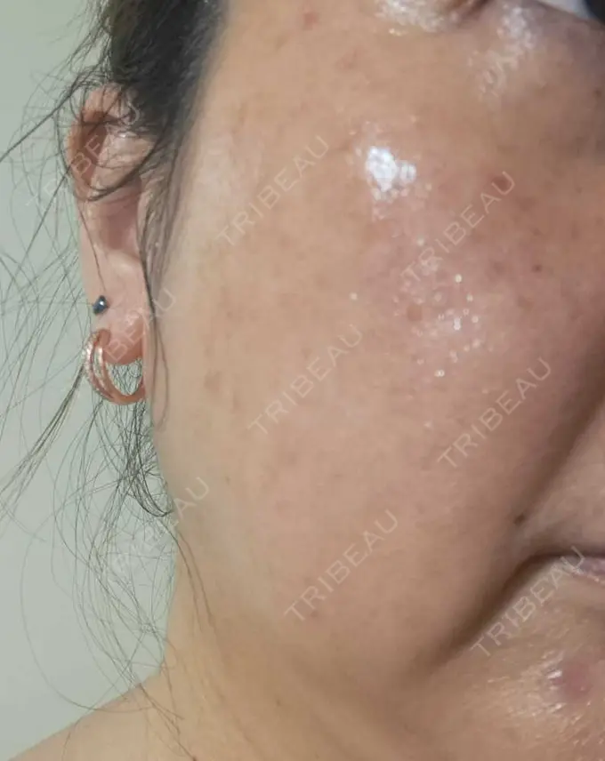 水光注射（ハリ・美肌） しんゆり美容健康クリニック DAY 6 メイン用