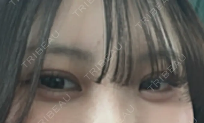 二重埋没 / 自然癒着法 東京シンデレラ美容外科 池袋院 DAY 22 メイン用