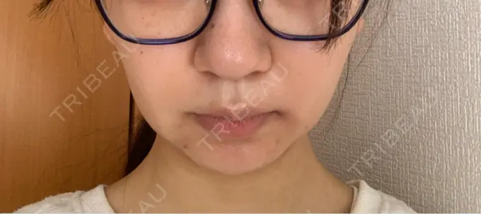 ボトックス（エラ・小顔） AYANAフィラーズクリニック 渋谷院 DAY 1 メイン用