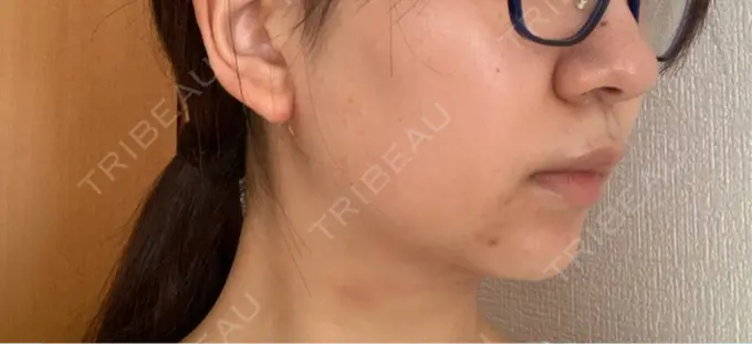 ボトックス（エラ・小顔） AYANAフィラーズクリニック 渋谷院 DAY 1 メイン用