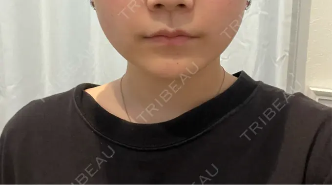 ボトックス（エラ・小顔） 大美会クリニック 岡山院 DAY 1 メイン用