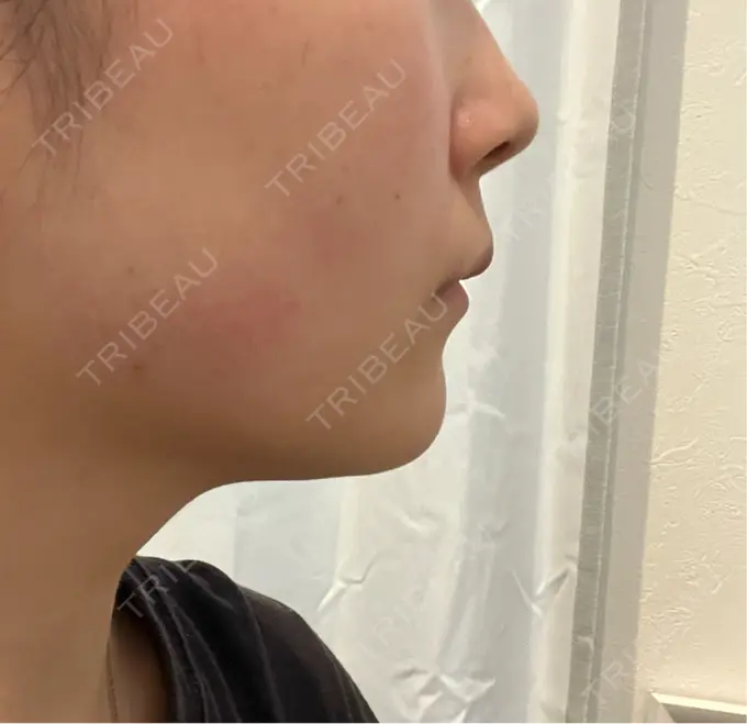 ボトックス（エラ・小顔） 大美会クリニック 岡山院 DAY 1 メイン用