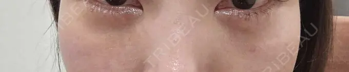 ヒアルロン酸溶解 しのぶ皮膚科 DAY 3 メイン用