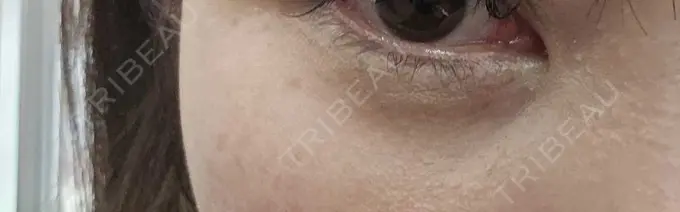 ヒアルロン酸溶解 しのぶ皮膚科 DAY 4 メイン用