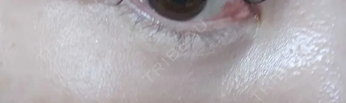 ヒアルロン酸溶解 しのぶ皮膚科 DAY 5 メイン用