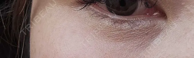 ヒアルロン酸溶解 しのぶ皮膚科 DAY 6 メイン用