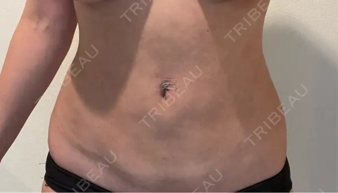 脂肪吸引（お腹） / 脂肪吸引（腰） オアシス美容外科 DAY 28 メイン用