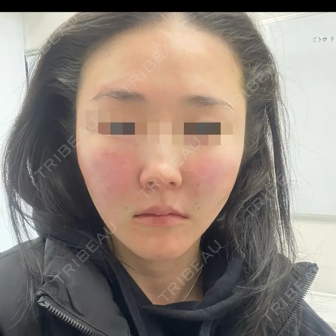 糸リフト / 脂肪吸引（顔） / メーラーファット除去 eクリニック 福岡院 DAY 0 メイン用