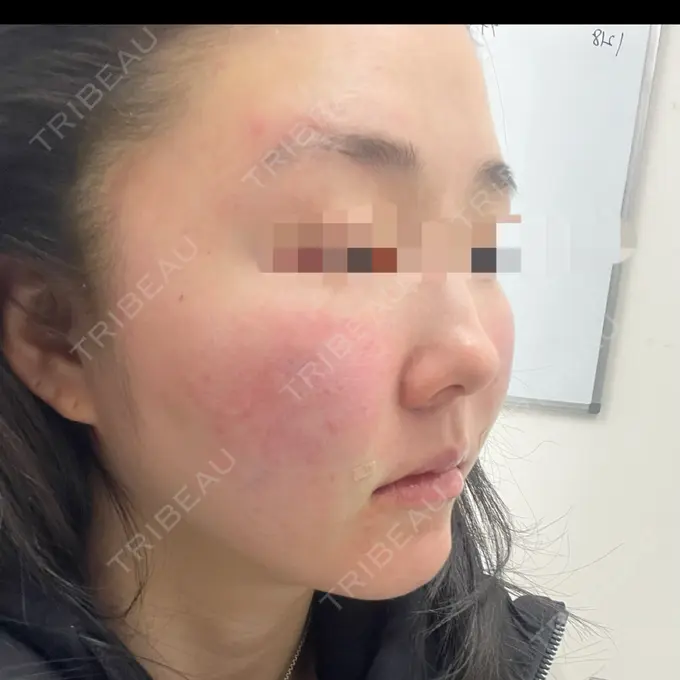 糸リフト / 脂肪吸引（顔） / メーラーファット除去 eクリニック 福岡院 DAY 0 メイン用