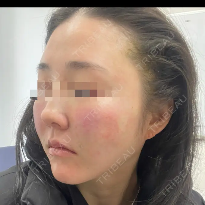 糸リフト / 脂肪吸引（顔） / メーラーファット除去 eクリニック 福岡院 DAY 0 メイン用