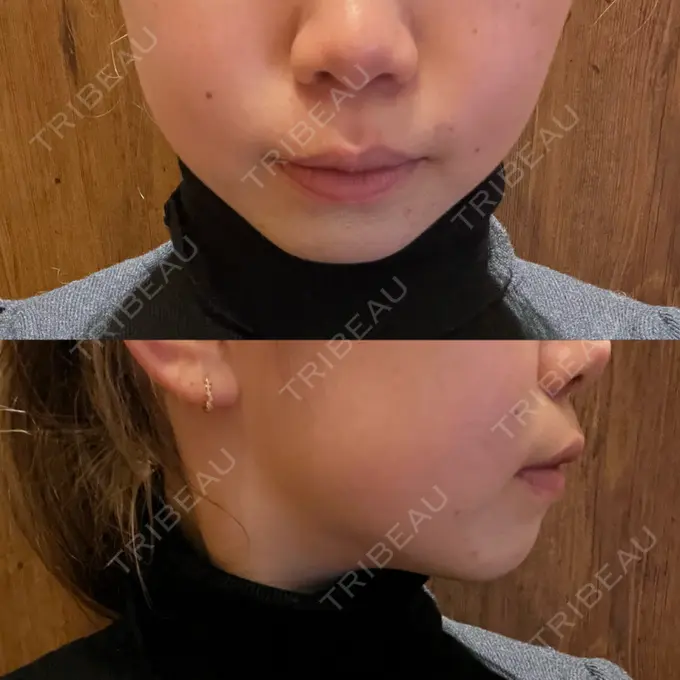 RF（高周波）たるみ治療 大美会クリニック 梅田院 DAY 3 メイン用