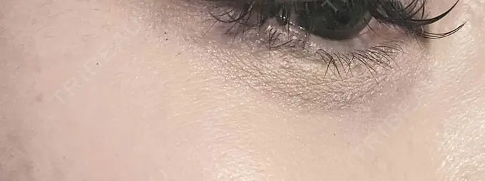 ヒアルロン酸溶解 しのぶ皮膚科 DAY 7 メイン用