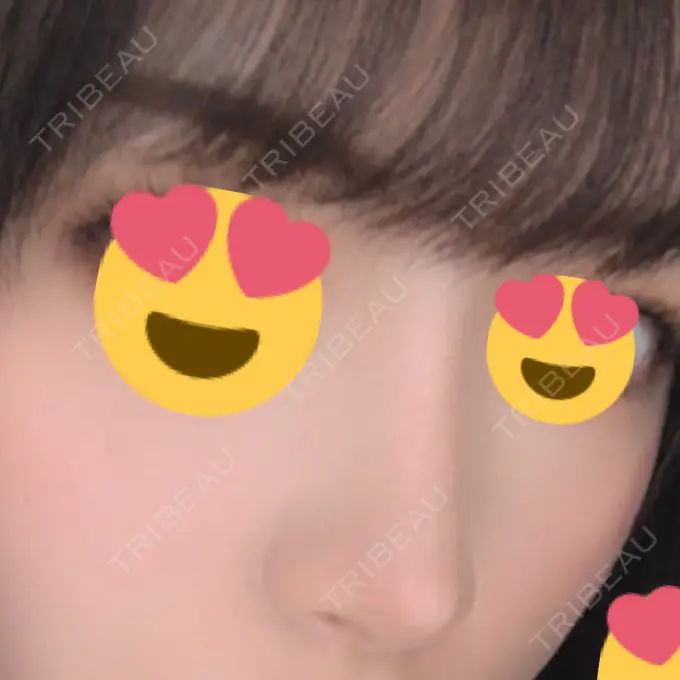 隆鼻術 / 軟骨移植 / プロテーゼ除去 FROM B整形外科 (旧バウム整形外科) AFTER メイン用