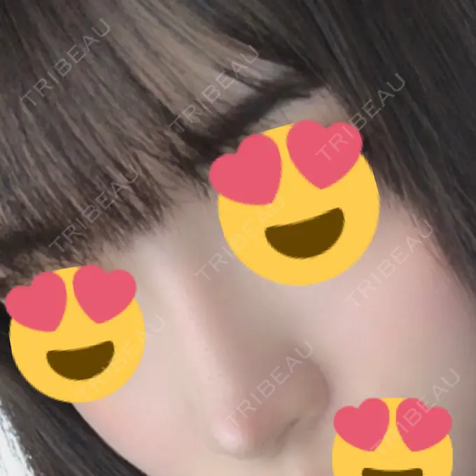 隆鼻術 / 軟骨移植 / プロテーゼ除去 FROM B整形外科 (旧バウム整形外科) DAY 326 メイン用