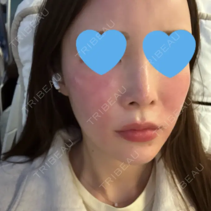 ハイフ（顔） / ミラノリピール 表参道メディカルクリニック 福岡天神院 DAY 1 メイン用