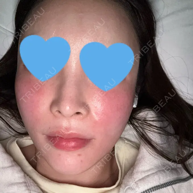 ハイフ（顔） / ミラノリピール 表参道メディカルクリニック 福岡天神院 DAY 2 メイン用