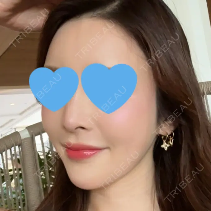 ハイフ（顔） / ミラノリピール 表参道メディカルクリニック 福岡天神院 DAY 4 メイン用